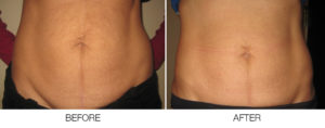 Before and after photo of SkinTyte at AVIE! Medspa in Leesburg, VA.
